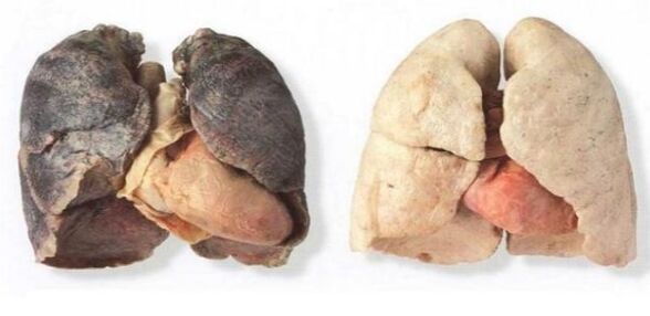 pulmones de fumadores y no fumadores