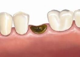 complicaciones después de la extracción de dientes