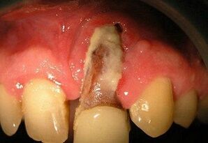 osteomielitis después de la extracción de dientes