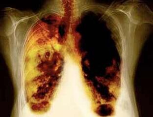 lesiones pulmonares al usar nicotina